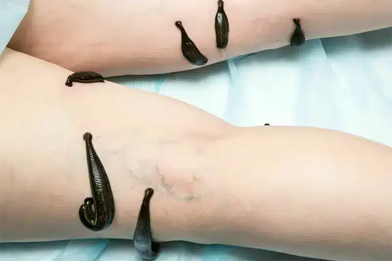 ทำนายฝัน ฝันเห็นปลิงเกาะ โดนปลิงดูดเลือด พร้อมเลขเด็ดมงคลส่องโชค